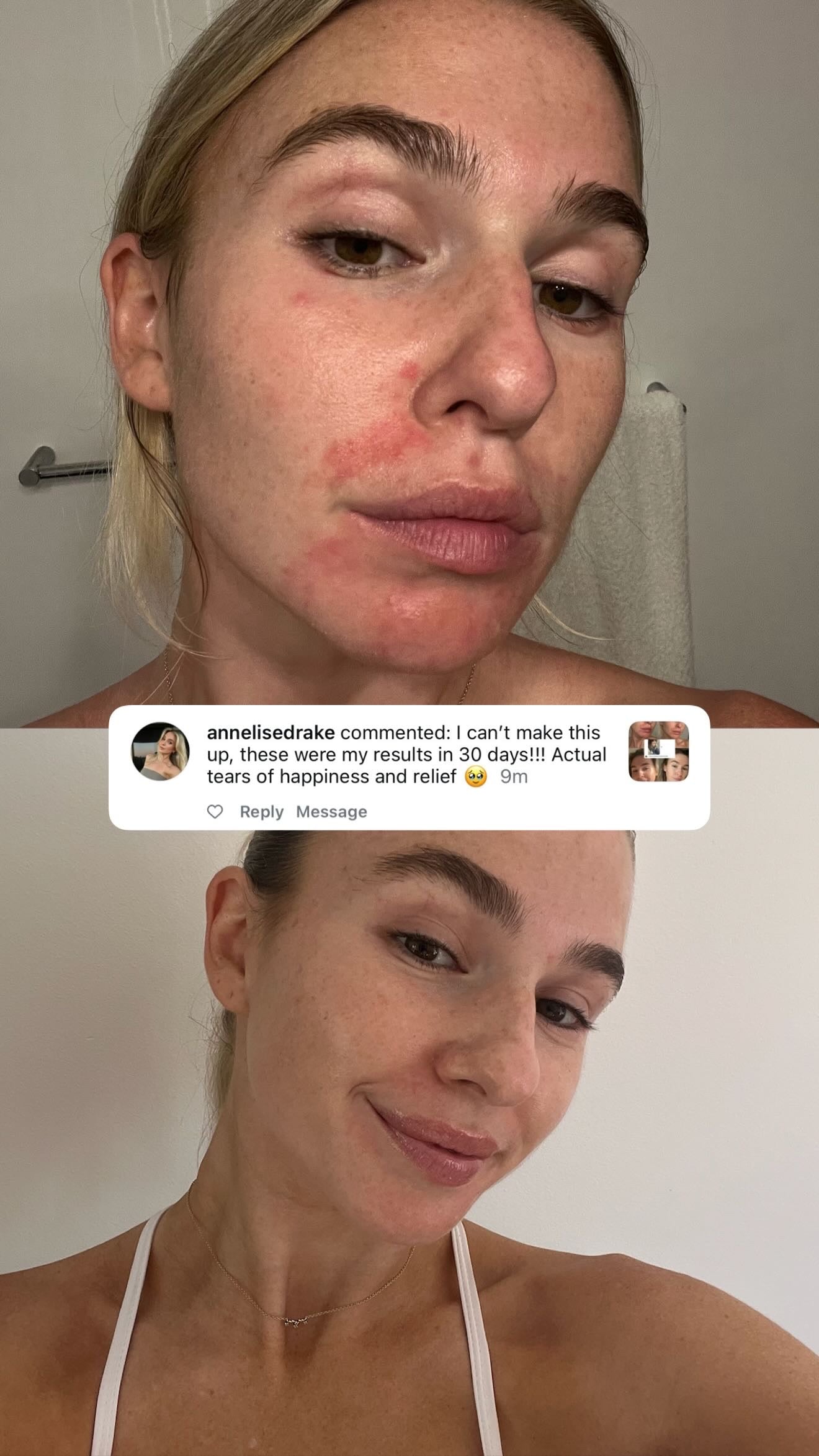 Understanding Perioral Dermatitis: Causes, Triggers & Support